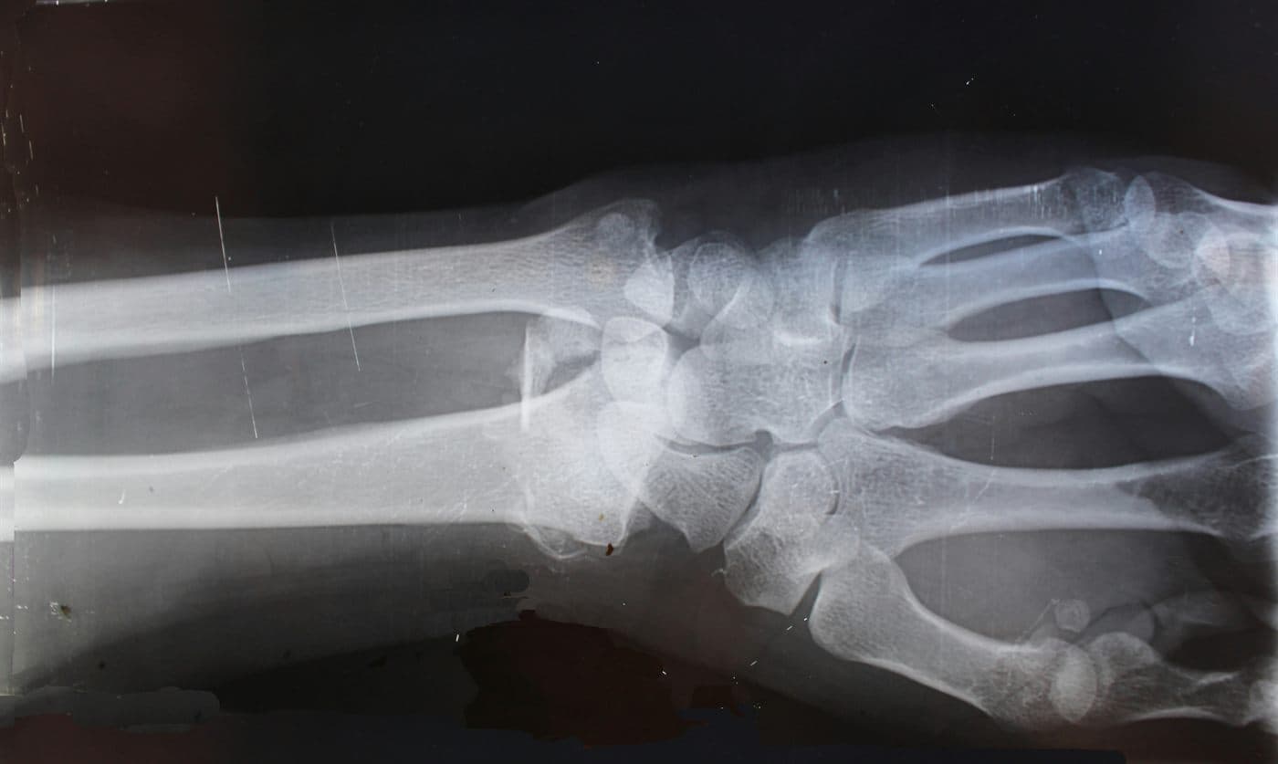 A plain X-ray of a wrist and forearm