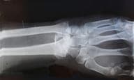 Completing a short health history on a phone